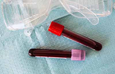 血浆D―二聚体的检测和血气分析在慢性阻塞性肺病中的诊断价值
